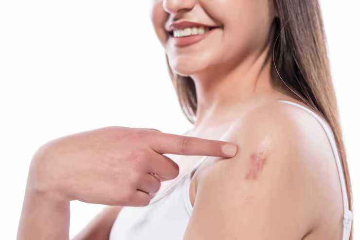 Your Guide to Effective Scar Treatment: Reclaiming Smooth Skin