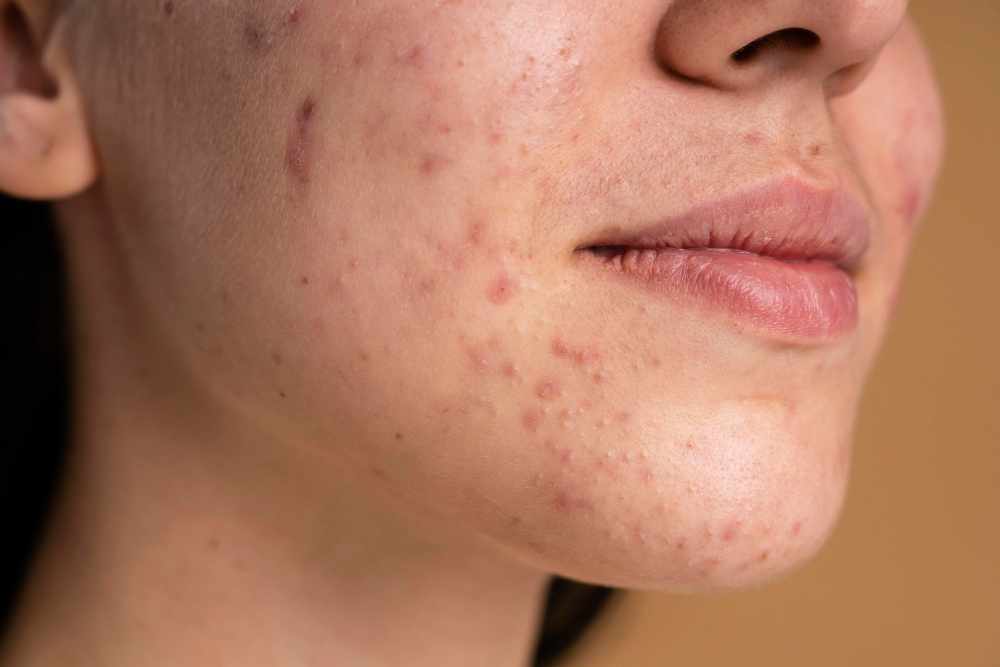 Navigating the Best Acne Treatment Options