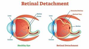 Retinal Detachment Surgery in Dubai for Expats