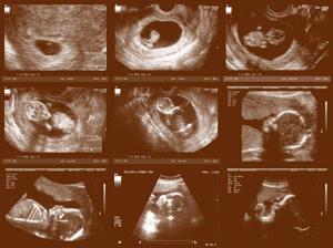 The ultrasound