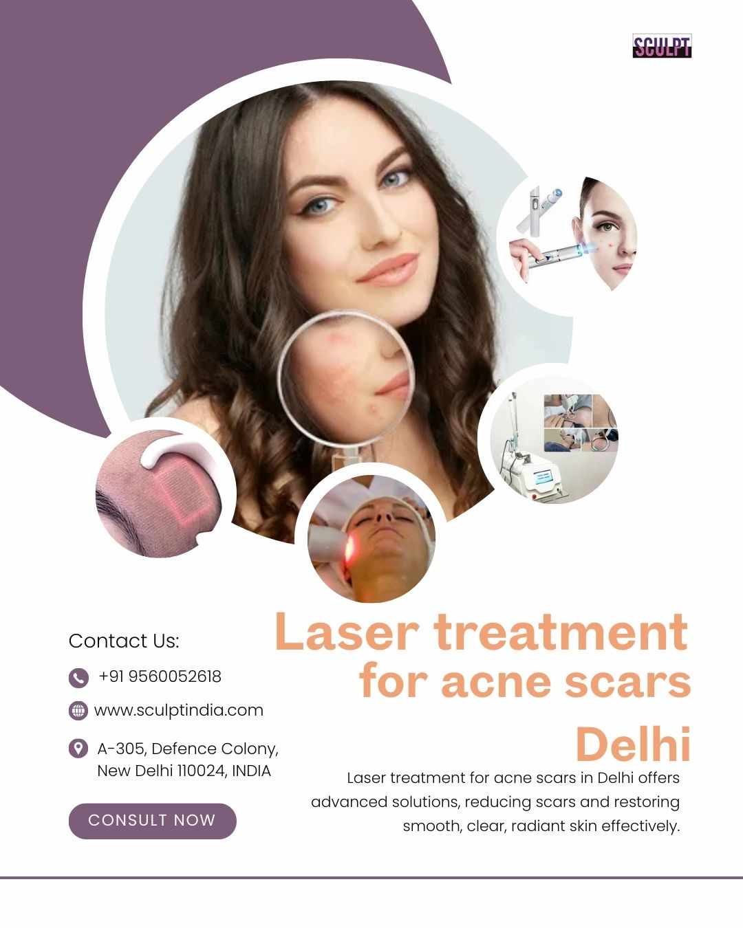 Laser Treatment for Acne Scars Delhi