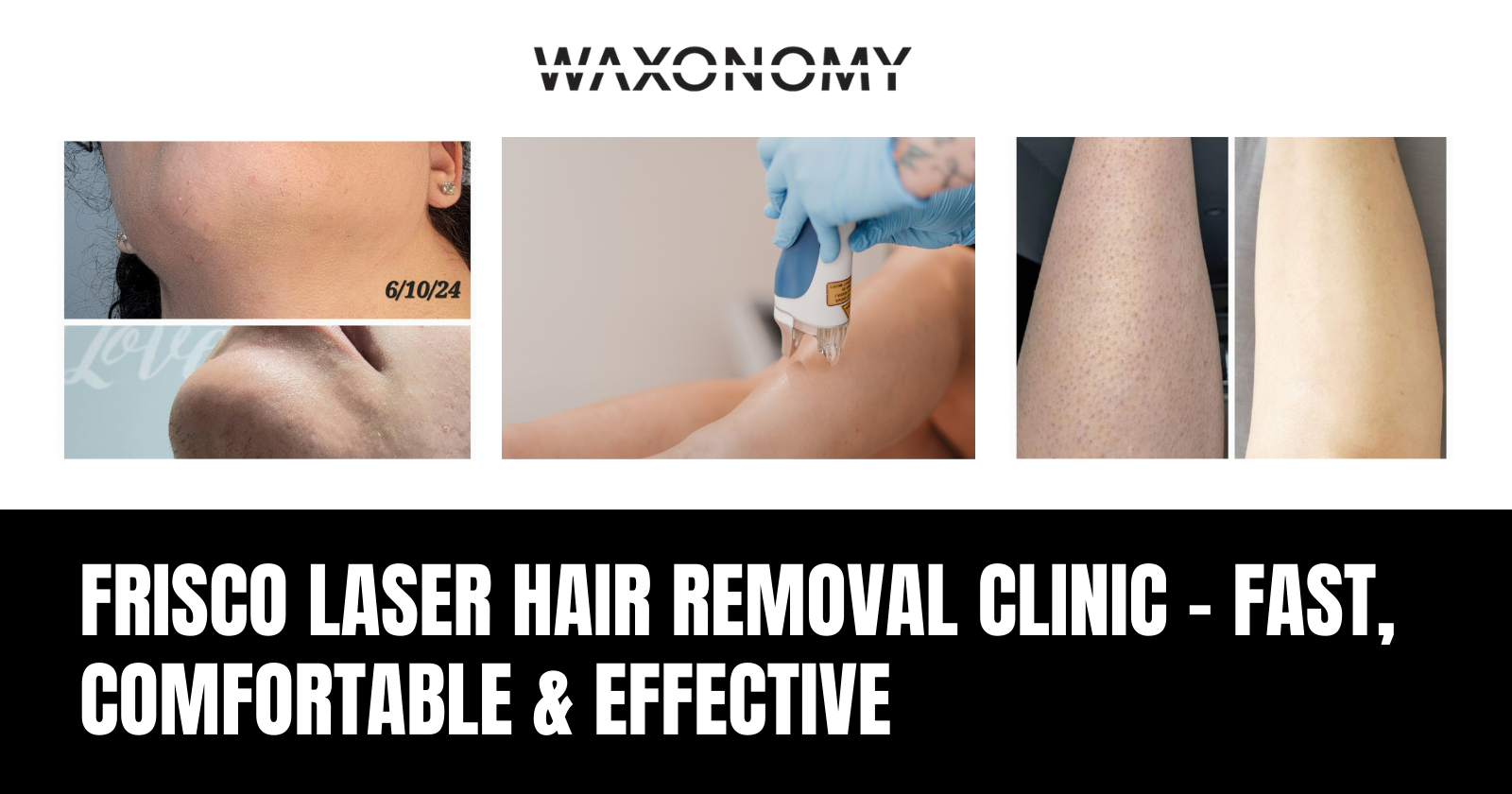 Frisco Laser Hair Removal Clinic Using Advanced SplendorX Technology