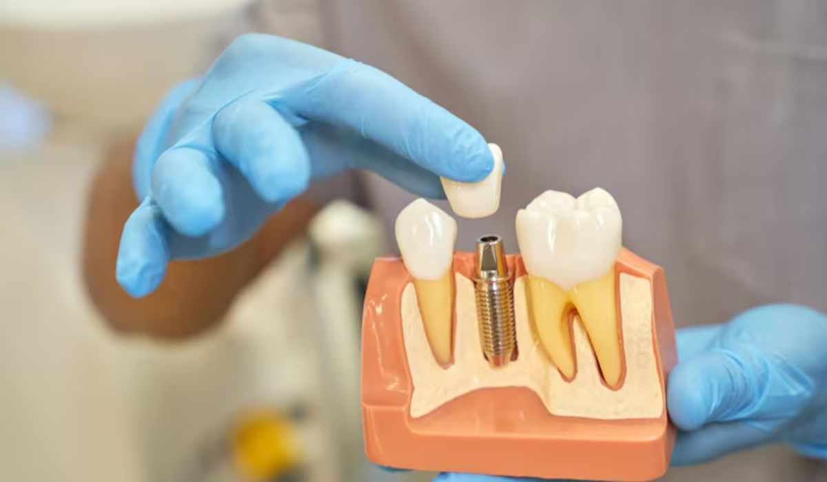 What Is the Process for Getting Dental Implants in Burbank?