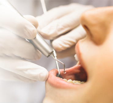 Laser vs Traditional Root Canal: Understanding the Key Differences and Benefits