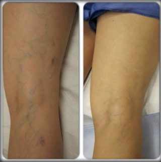 Venoxil Varicose France :  Repair Damaged Veins