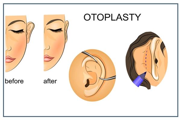 Otoplasty: Indications, Procedure & Recovery