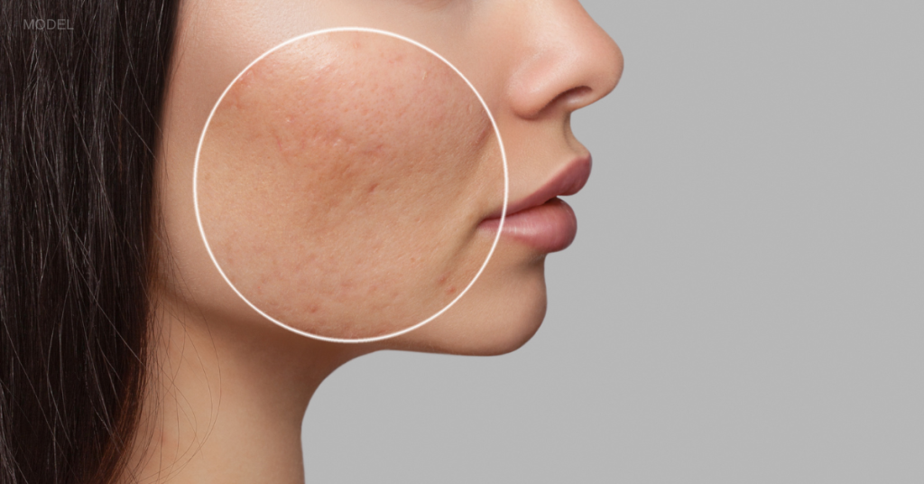 When Should You Visit a Dermatologist for Acne Treatment?