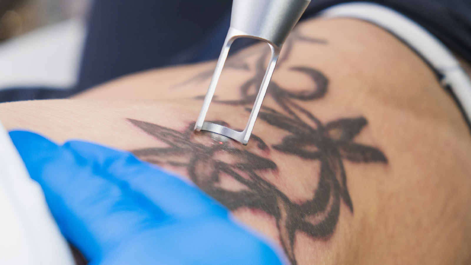 The Best Way to Get Tattoo Removal at Reputed Clinics in Bhubaneswar