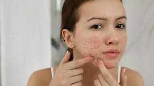 Effective Solutions for Clear Skin: Expert Acne Care in Bhubaneswar