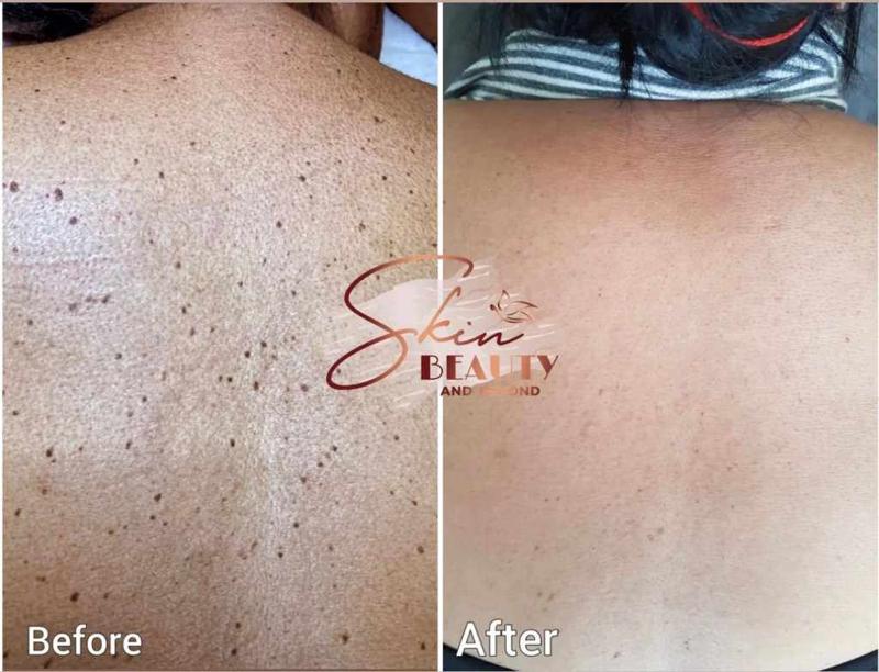Skin Classic High Frequency Treatment | Skinbeautyandbeyond.com