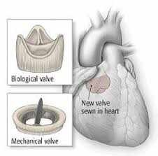 Prosthetic Heart Valves Market Patient Awareness & Education