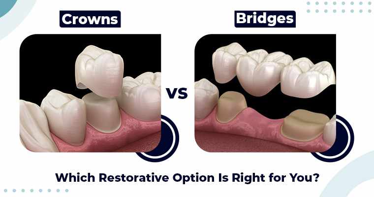 Crowns vs. Bridges: Which Restorative Option Is Right for You?