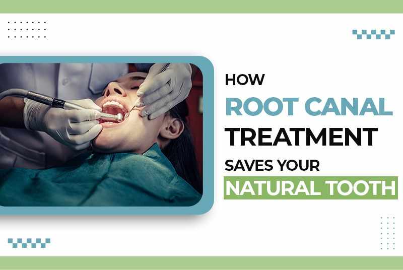 How Root Canal Treatment Saves Your Natural Tooth