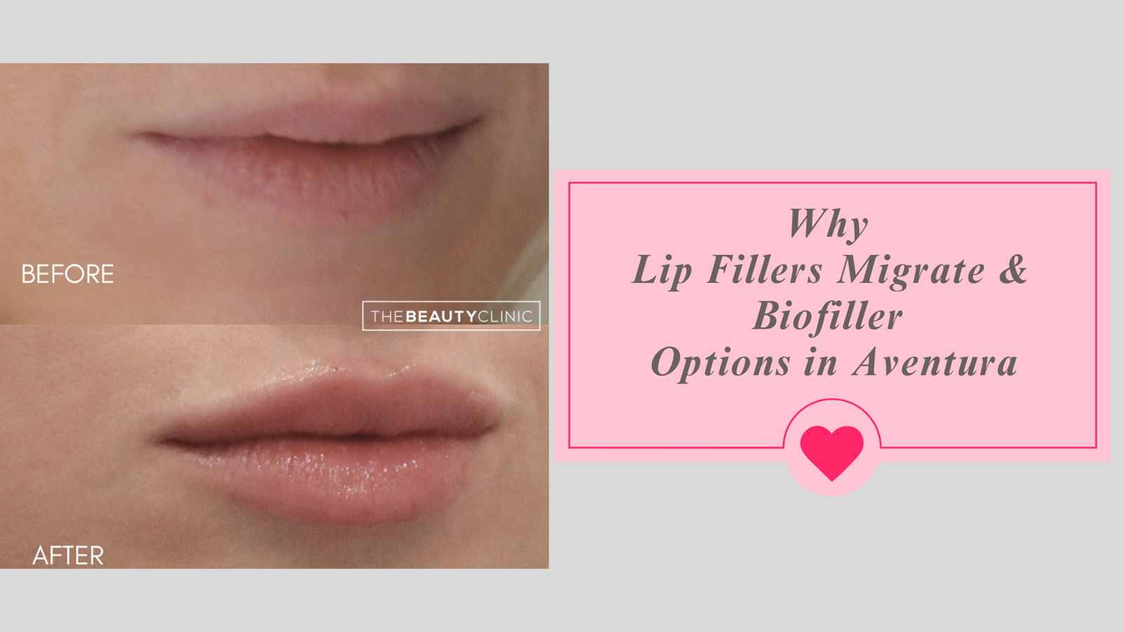 Why Lip Fillers Migrate & Biofiller Options in Aventura