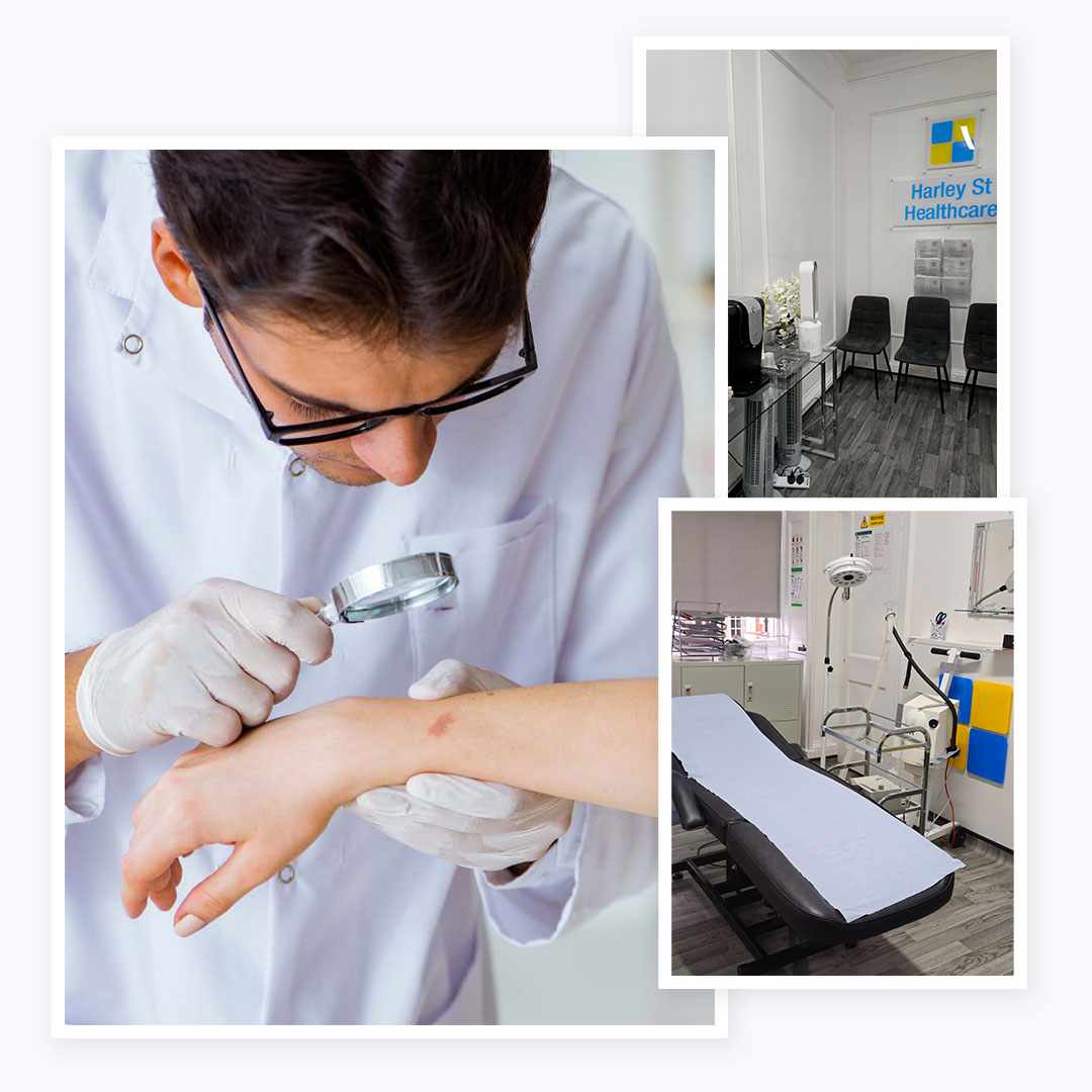 Skin Tag Removal Barnet: Safe Procedures, Costs & What to Expect