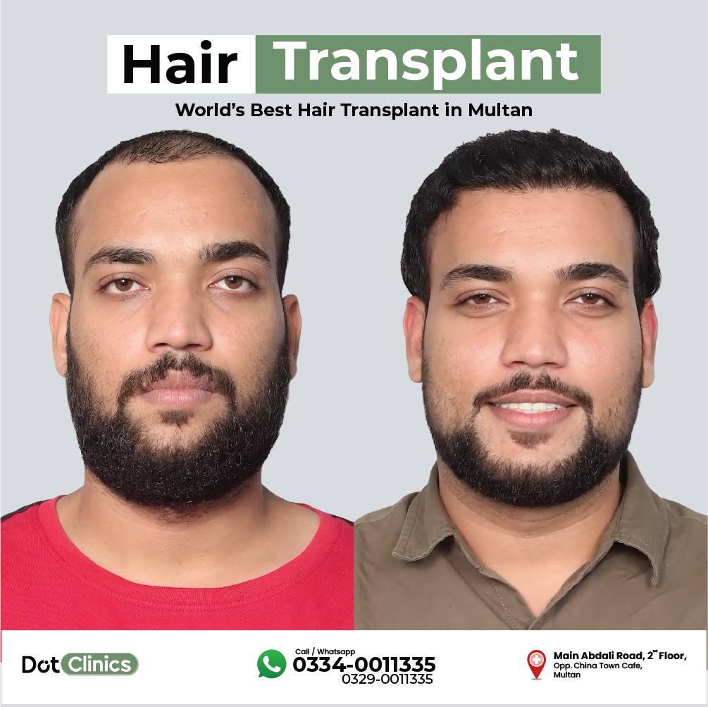 Hair Transplant Treatment in Pakistan