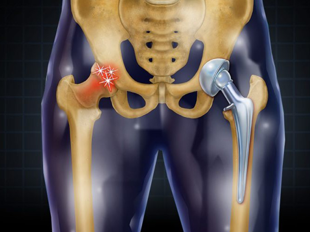 Understanding Modern Solutions for Hip Joint Problems