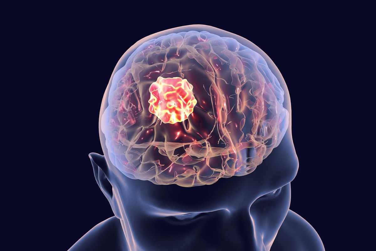 Common Reasons Doctors Recommend Brain Tumor Surgery