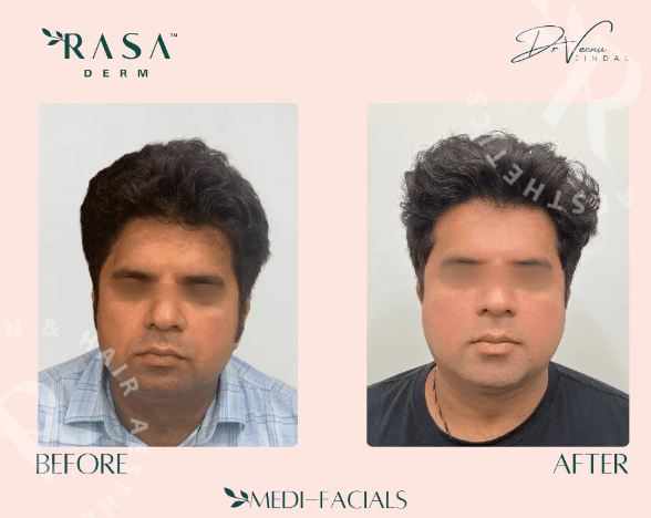 Our Advanced Carbon Facial Treatment!