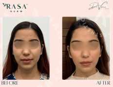 Aqualyx injections provide a non-surgical