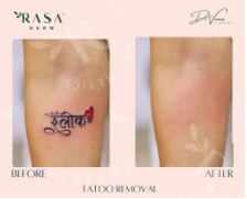 Tattoo Removal in Ashok Vihar