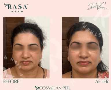 Cosmelan Peel price in Delhi