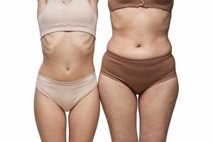 What to Expect Before and After the Liposuction Procedure