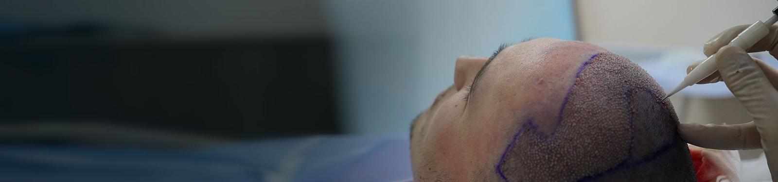 Why Should You Undergo the Best DHI Hair Transplant in Turkey?