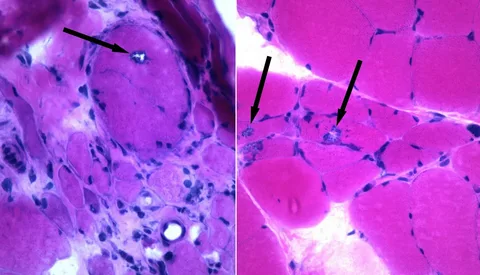 Inclusion Body Myositis Market Growth and Strategic Insights 2025-2032