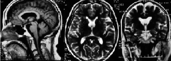 Multiple System Atrophy (MSA) Market: Size, Trends, and Growth Strategies
