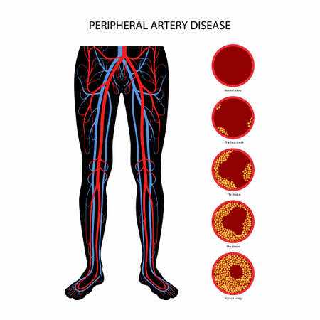 Peripheral Artery Disease (PAD) Market Size, Trends, and Growth Analysis 2025-2032