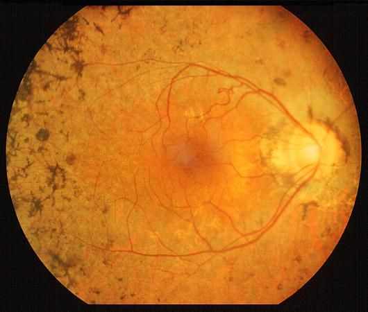 Retinis Pigmentosa Market Growth Analysis and Strategic Outlook 2025-2032