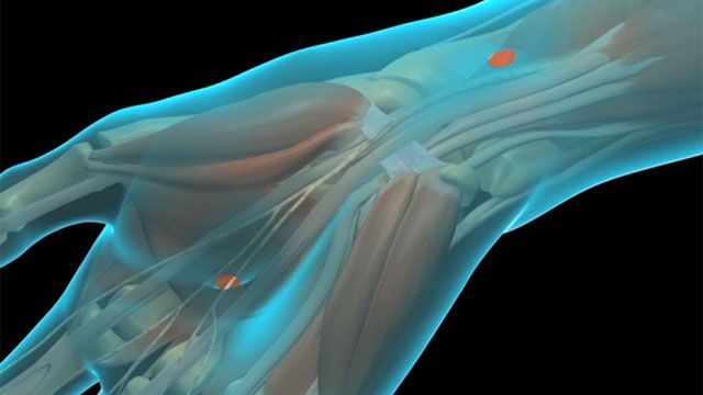 Carpal Tunnel Release System Market: Size, Growth, Trends, and Strategic Insights