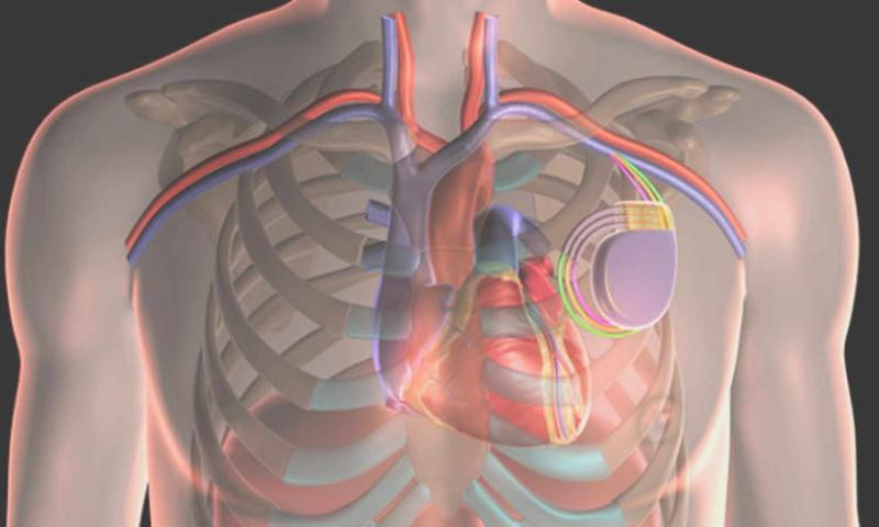 Cardiac Resynchronization Therapy Market Size, Trends, and Growth Analysis 2025-2032