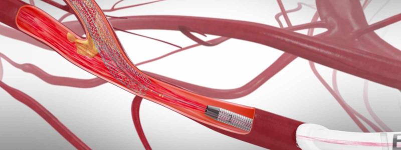Global Carotid Artery Stent Market Size, Trends, and Growth Analysis 2025-2032