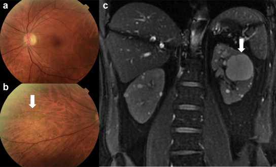 Alport Syndrome Market Size, Trends, and Growth Strategies: Global Analysis 2025-2032