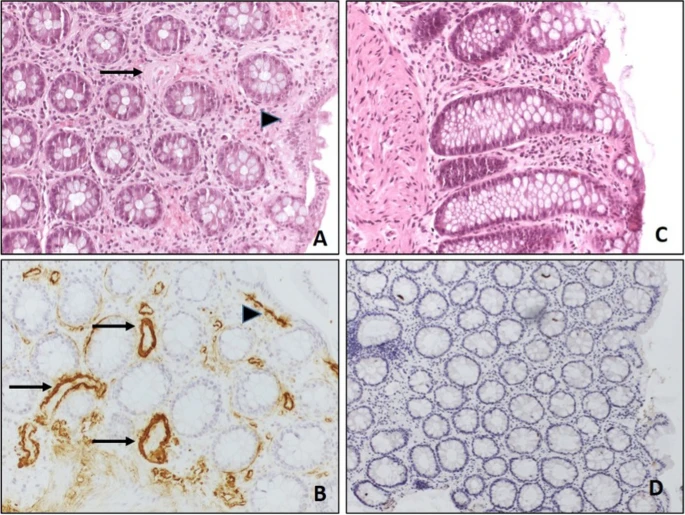 Systemic Amyloidosis Therapeutic Market: Size, Trends, and Growth Strategies