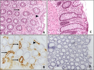 Systemic Amyloidosis Therapeutic Market: Size, Trends, and Growth Strategies
