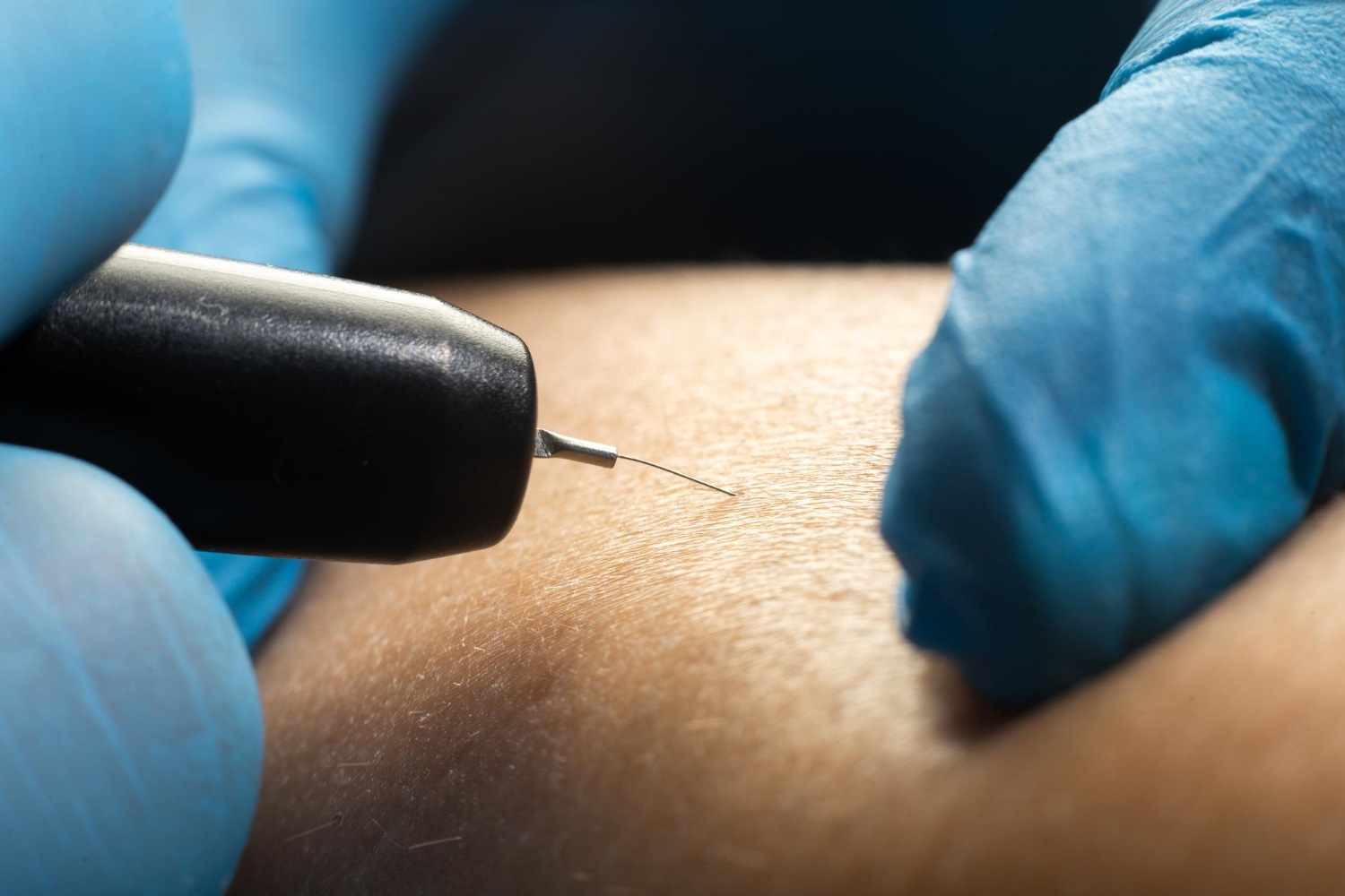 Electrolysis for Hormonal Hair Growth: What You Should Know