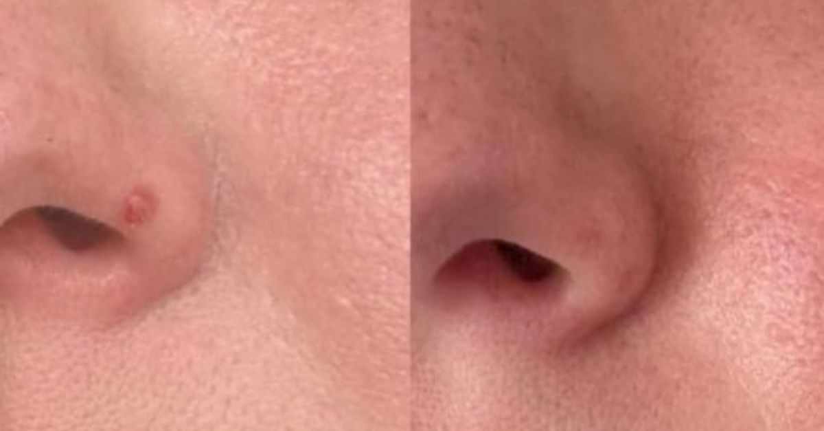 Why Do Fibrous Papules Appear on the Face?