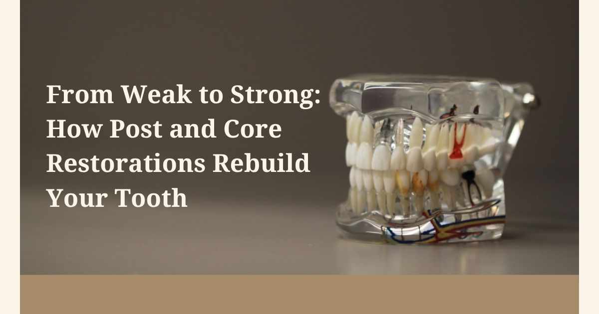 From Weak to Strong: How Post and Core Restorations Rebuild Your Tooth