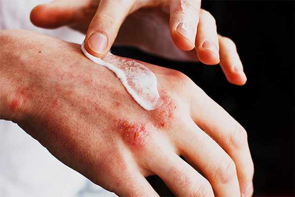 The Business of Allergies: Global Treatment Market to Nearly Double by 2034