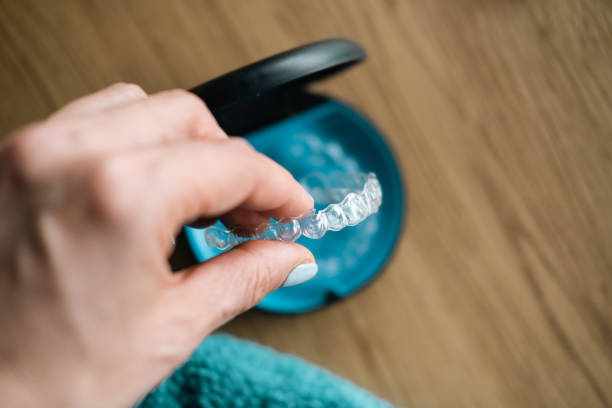 Clear Braces – Here is All That You Need To Know!