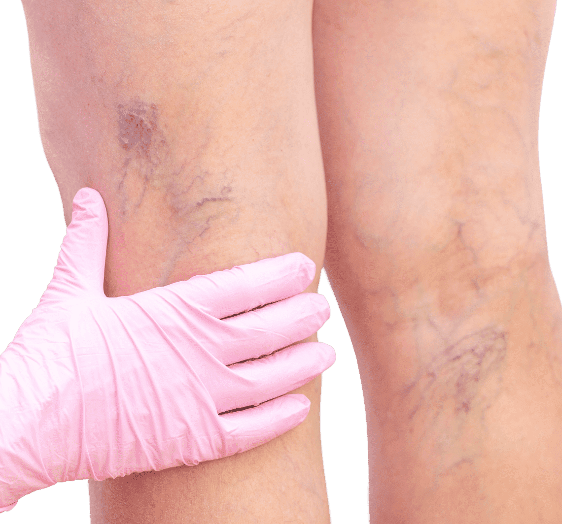 Best Varicose veins Treatment in Bangalore