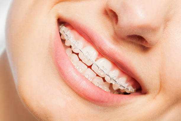 Beyond a Better Smile: How Orthodontic Treatment Can Improve Oral Health