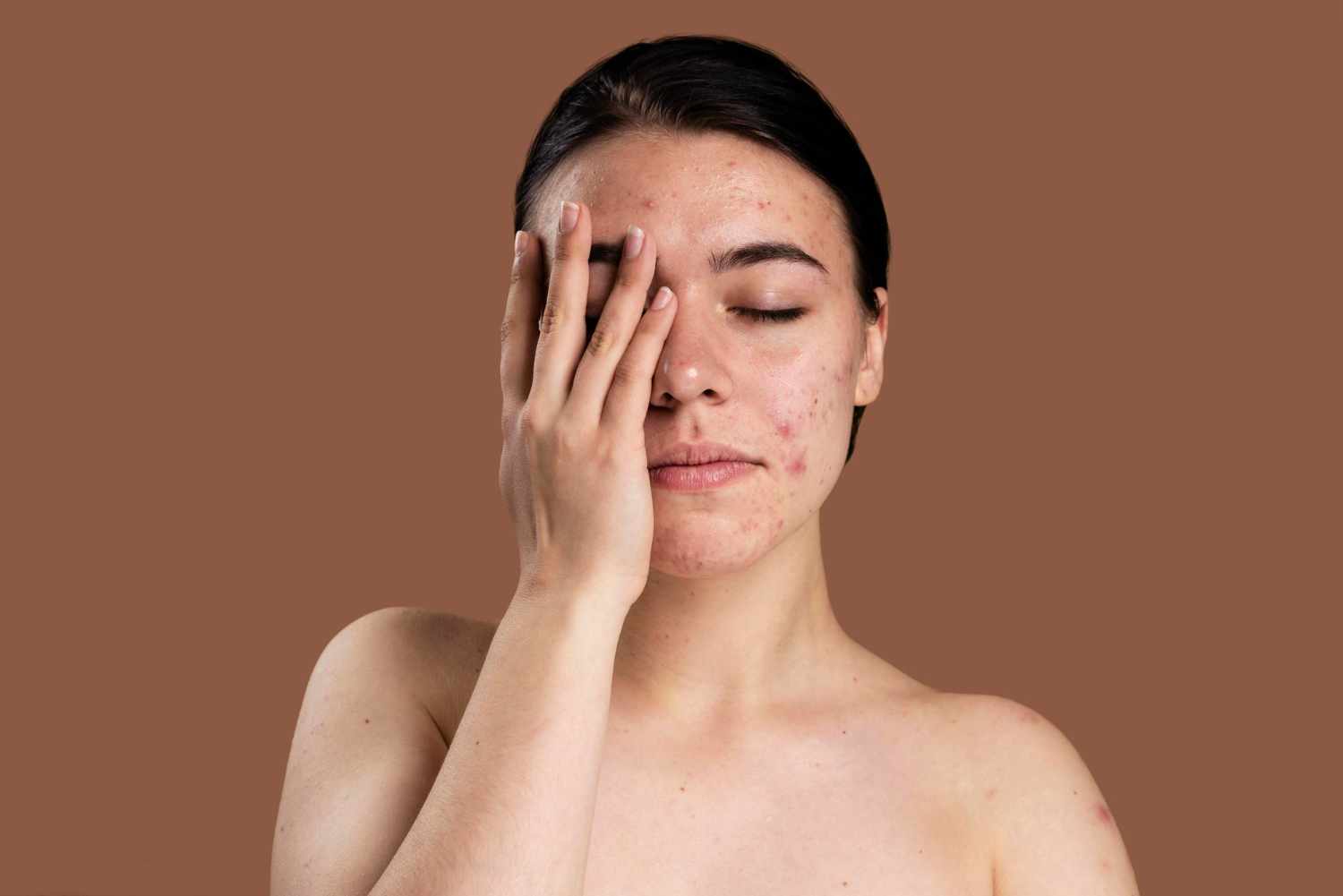 Expensive Branded Serums Treat Acne Scars - Truth or Myth?