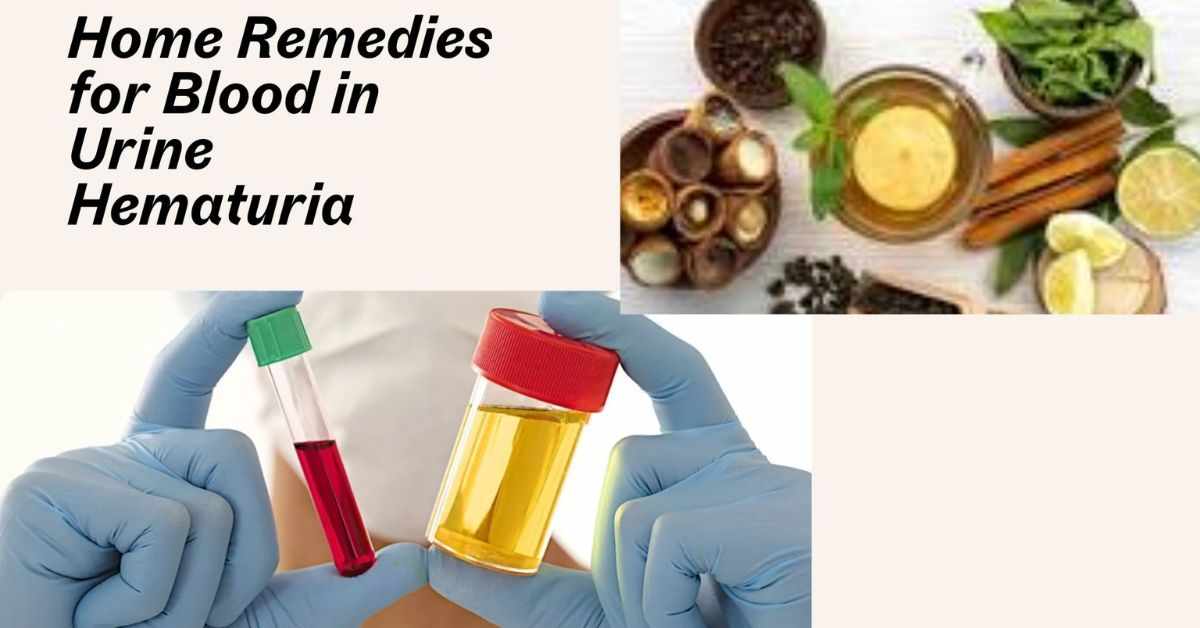 Home Remedies for Blood in Urine