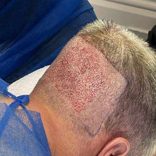 How to Find Best Hair Transplant in Delhi A Completely Guided to Lasting Natural Results