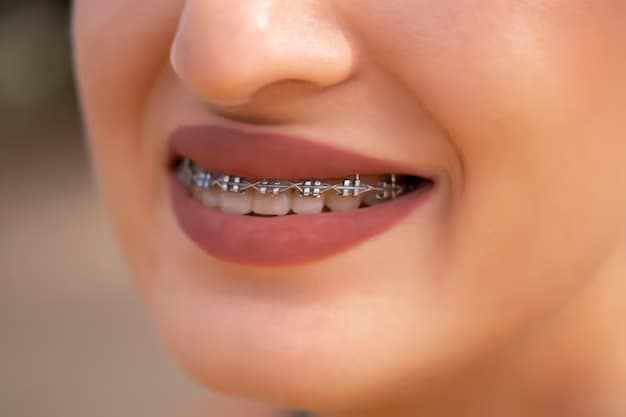 Benefits of Choosing Traditional Metal Braces for Straighter Teeth