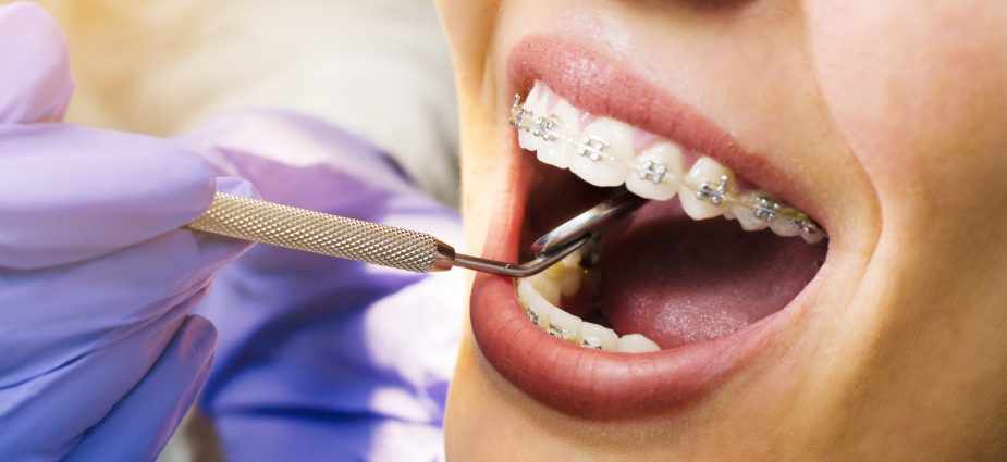 Is Braces Treatment Worth It? Benefits for Oral Health and Confidence